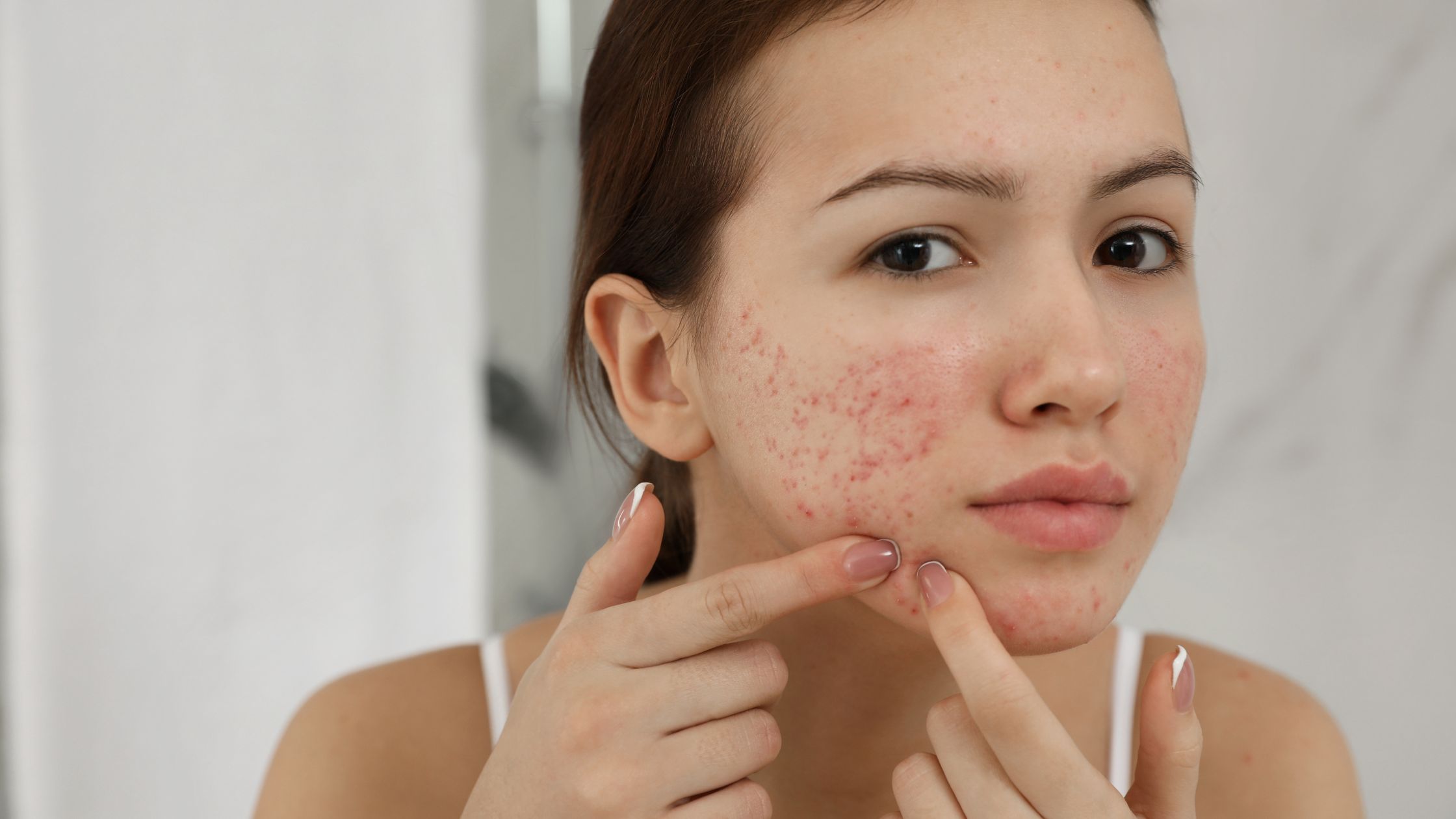 Acne: Understanding It and How to Take Control